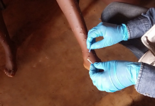 Afurika: Abagaragaje ibimenyetso bya Mpox muri 2024, 37% nibo bapimwe
